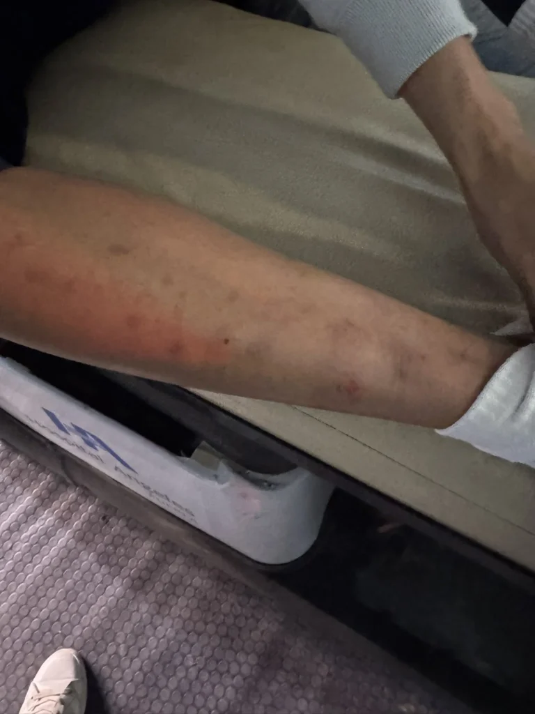 Fotografía de la pierna de Kevin Mier tras la temeraria infracción que padeció.